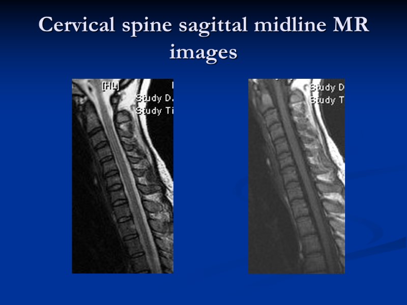 Cervical spine sagittal midline MR images
